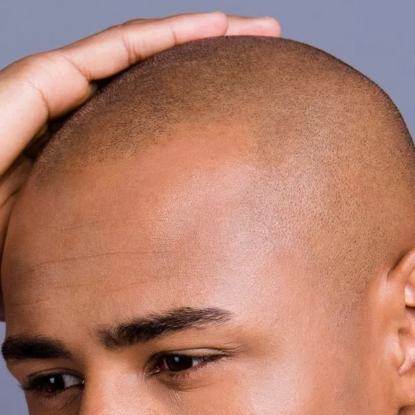 Scalp Micropigmentation