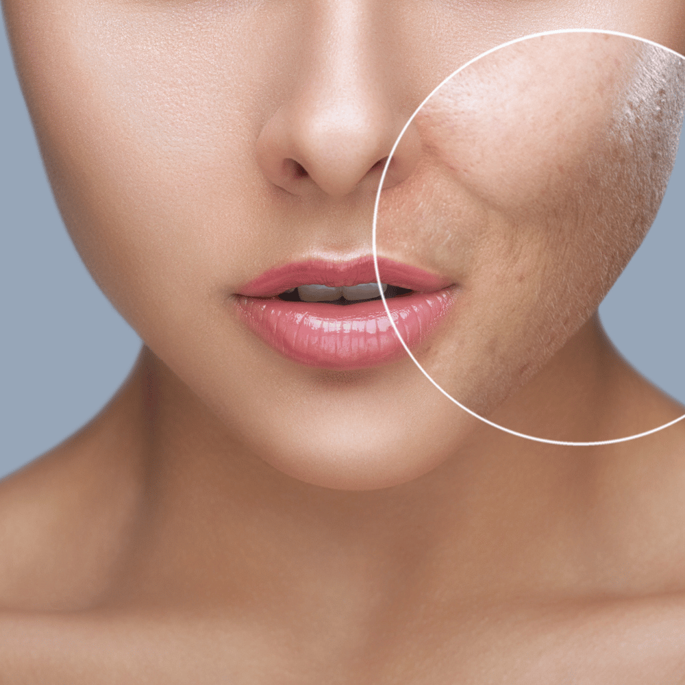 PROCELL CAN HELP REDUCE FACIAL BLEMISHES in lousiville