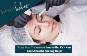 Acne Scar Treatment Louisville, KY - How Can Microchanneling Help