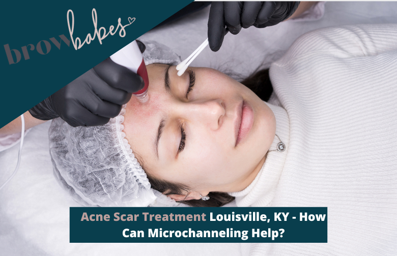 Acne Scar Treatment Louisville, KY - How Can Microchanneling Help